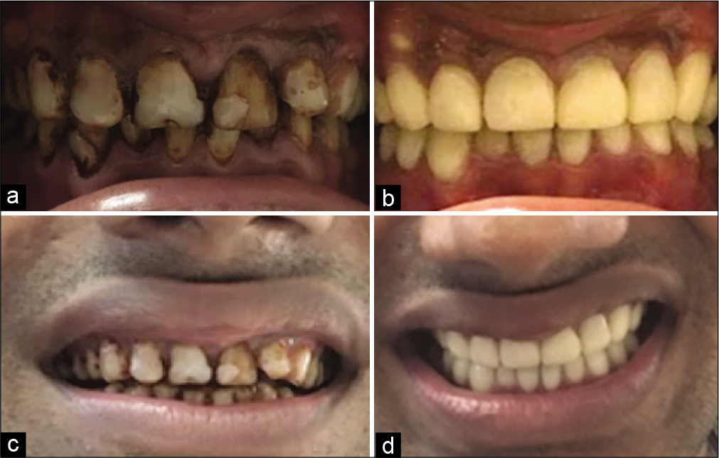 (a) Frontally centered pre-operative intra-oral photograph showing generalized moderate to severe fluorosis stains (b) frontally centered post-operative intra-oral photograph showing aesthetic rehabilitation with full-coverage crowns (c) Face-frontal (smiling) pre-operative photograph (d) Face-frontal (smiling) post-operative photograph.